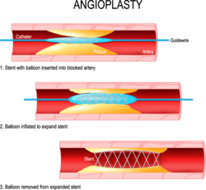 Angioplasty - What You Need To Know? - KC Science Talks