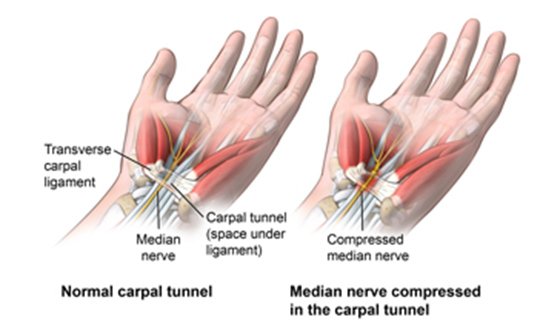 Anterior view of wrist comparing a healthy carpal tunnel with a compressed median nerve in the carpal tunnel; AMuscsk_20140312_v0_003;

SOURCE: ortho_carp-tun-rel-endo_anat.ai; AMuscsk_20140312_v0_003_Layers.psd